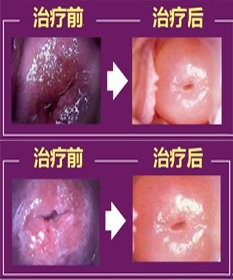 宫颈糜烂