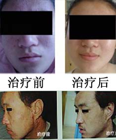 皮炎