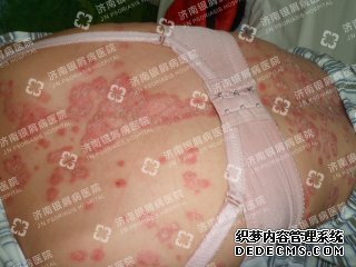 女性患牛皮癣的症状表现