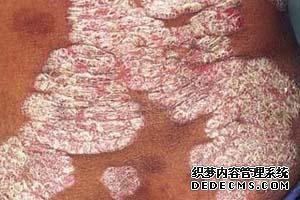 儿童患有银屑病病因