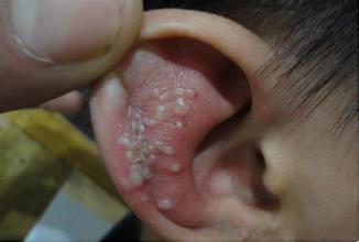外耳湿疹诊断方法